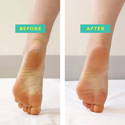 Masque pour les Pieds - POSHPEEL™ Pedi Cure XL
